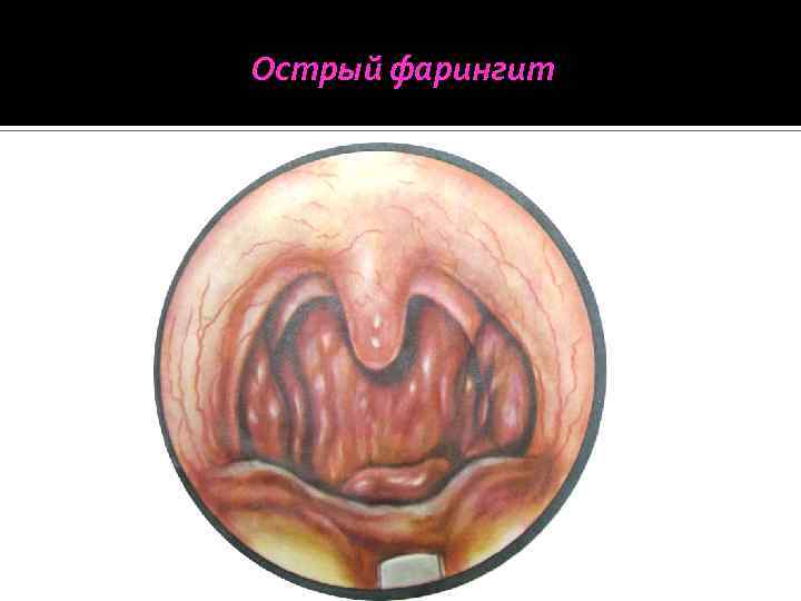 Острый фарингит 