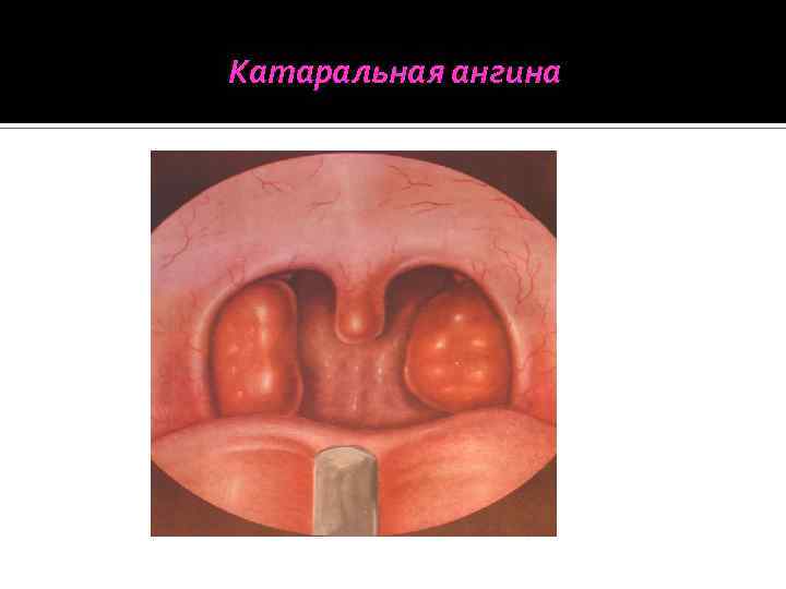 Катаральная ангина 