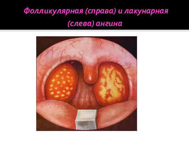 Фолликулярная (справа) и лакунарная (слева) ангина 