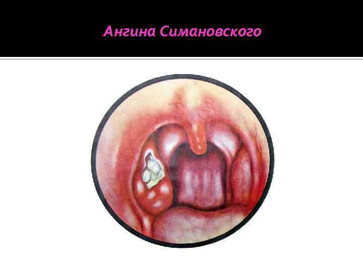 Ангина Симановского 