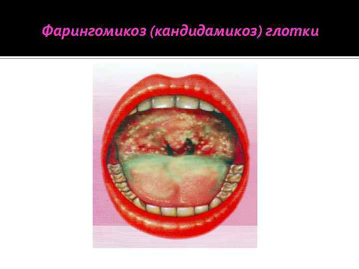 Фарингомикоз (кандидамикоз) глотки 