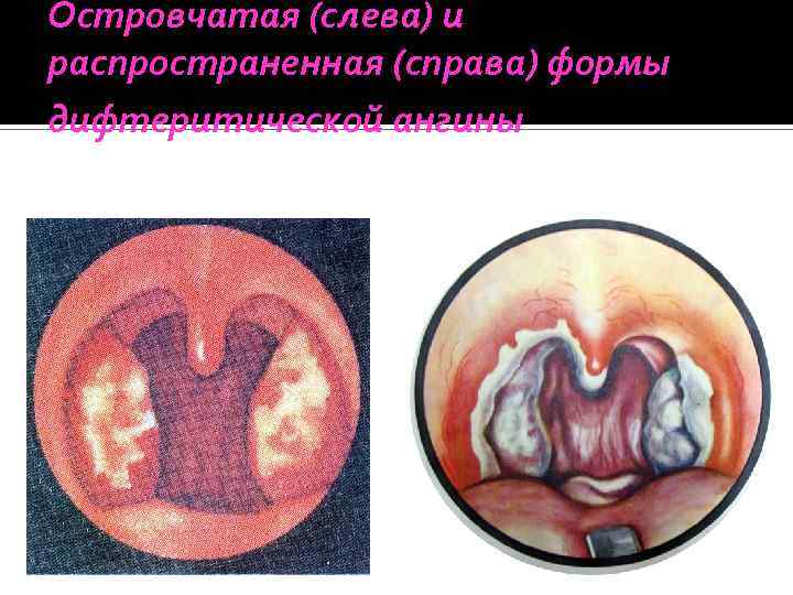 Островчатая (слева) и распространенная (справа) формы дифтеритической ангины 