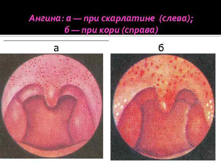 Небно глоточная дужка фото