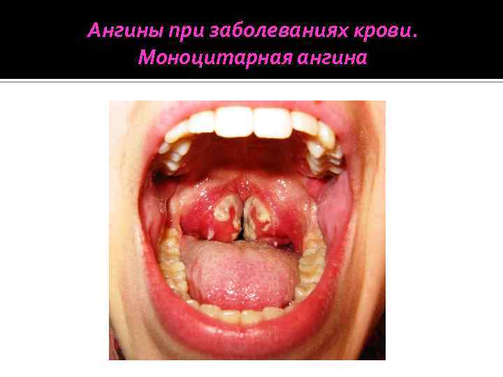Ангины при заболеваниях крови. Моноцитарная ангина 