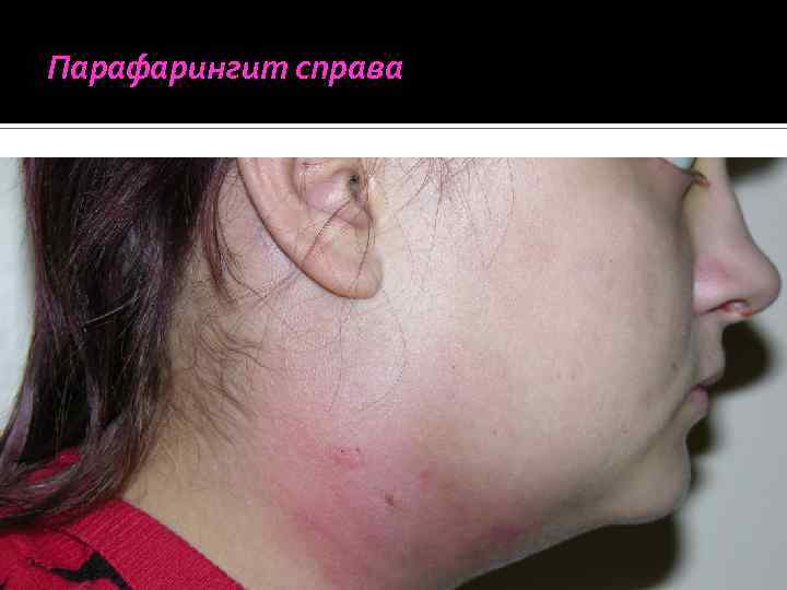 Парафарингит справа 