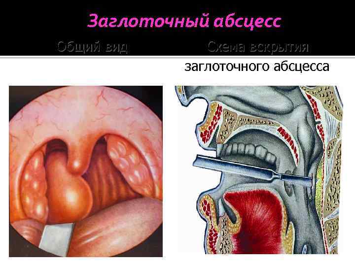 Заглоточный абсцесс Общий вид Схема вскрытия заглоточного абсцесса 