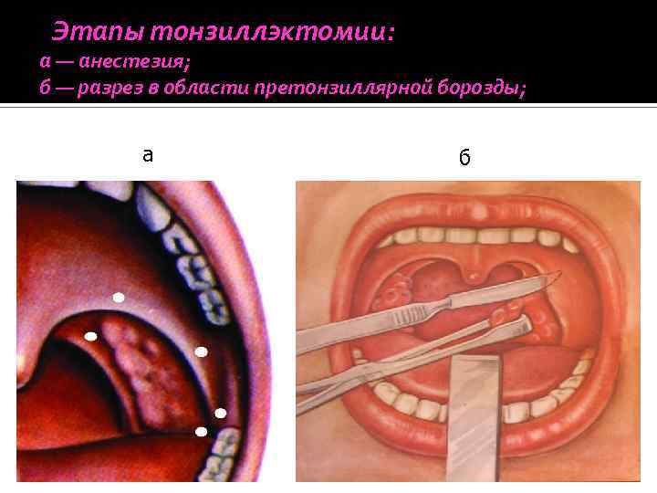 Этапы тонзиллэктомии: а — анестезия; б — разрез в области претонзиллярной борозды; а б