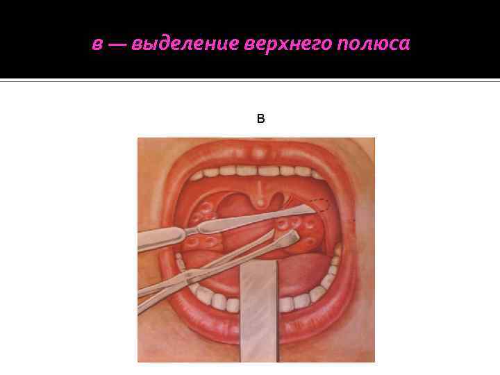 в — выделение верхнего полюса в 