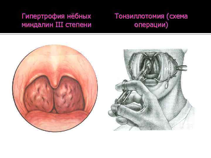 Киста небной миндалины фото