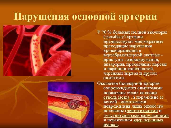 Нарушения основной артерии    У 70 % больных полной закупорке  