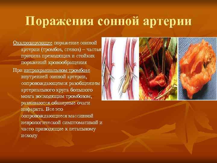  Поражения сонной артерии Окклюзирующее поражение сонной артерии (тромбоз, стеноз) – частая причина преходящих