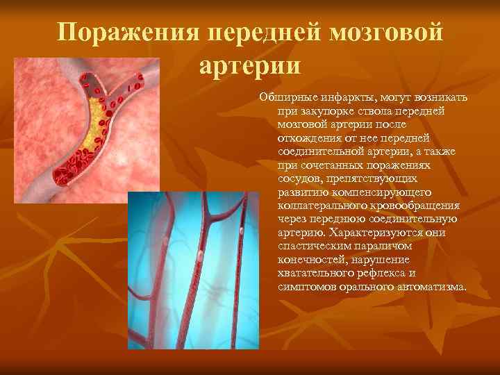 Поражения передней мозговой   артерии    Обширные инфаркты, могут возникать 