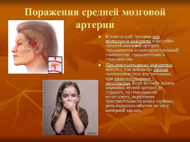 Поражения средней мозговой   артерии   n  Клинический синдром при 