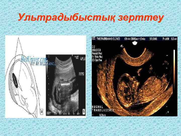 Ультрадыбыстық зерттеу 