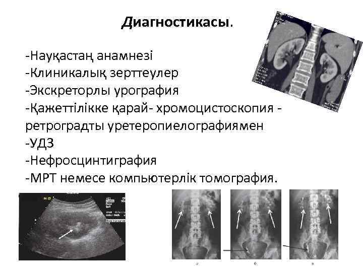    Диагностикасы.  -Науқастаң анамнезі -Клиникалық зерттеулер -Экскреторлы урография -Қажеттілікке қарай- хромоцистоскопия