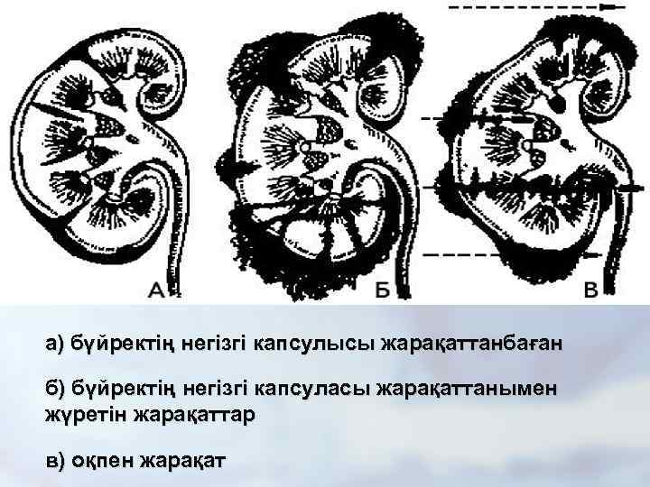 а) бүйректің негізгі капсулысы жарақаттанбаған б) бүйректің негізгі капсуласы жарақаттанымен жүретін жарақаттар в) оқпен