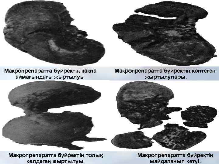 Макропрепаратта бүйректің қақпа  Макропрепаратта бүйректің көптеген  аймағындағы жыртылуы.    