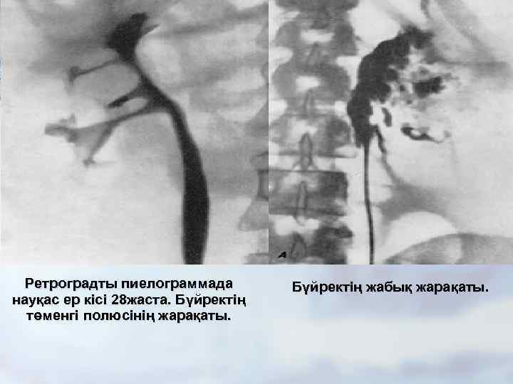  Ретроградты пиелограммада   Бүйректің жабық жарақаты. науқас ер кісі 28 жаста. Бүйректің