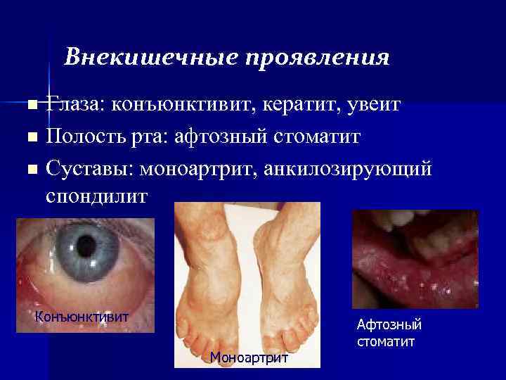 Внекишечные проявления n Глаза: конъюнктивит, кератит, увеит n Полость рта: афтозный стоматит Внекишечные проявления n Глаза: конъюнктивит, кератит, увеит n Полость рта: афтозный стоматит