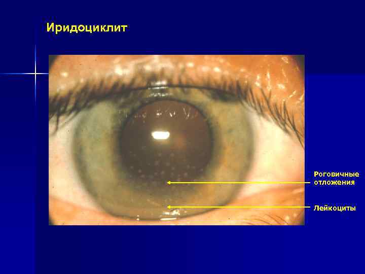Иридоциклит Роговичные отложения Лейкоциты Иридоциклит Роговичные отложения Лейкоциты