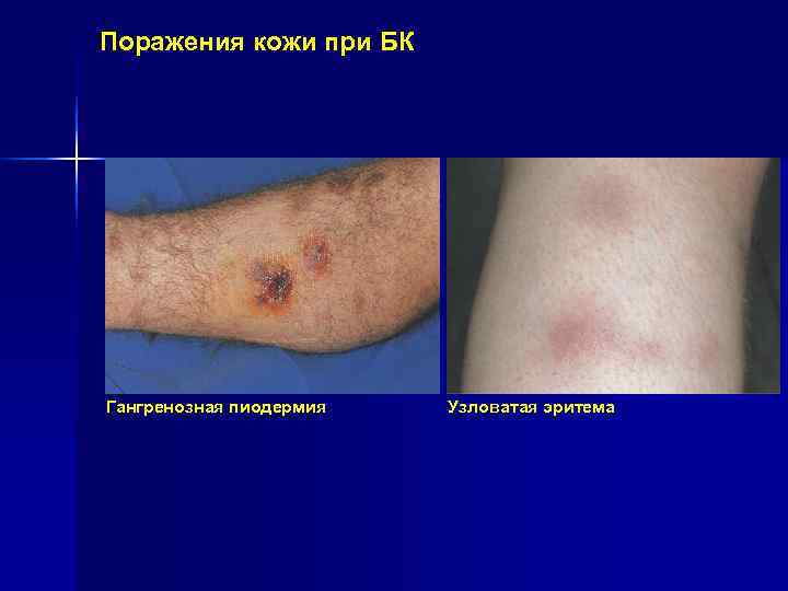 Поражения кожи при БК Гангренозная пиодермия Узловатая эритема Поражения кожи при БК Гангренозная пиодермия Узловатая эритема