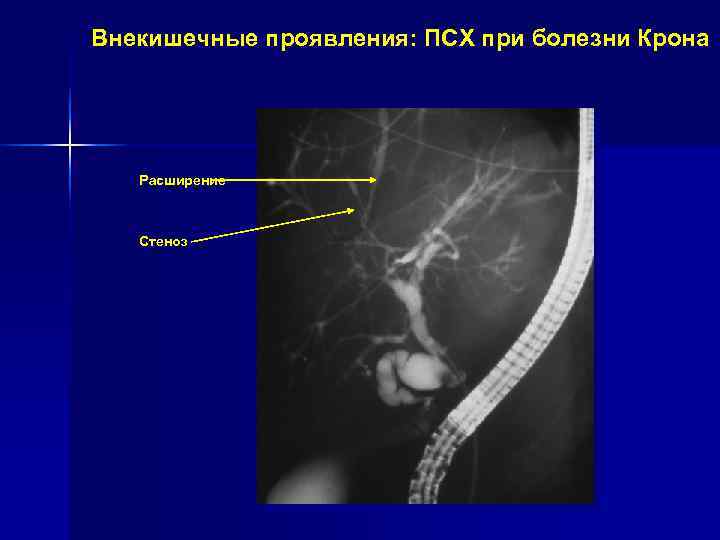 Склерозированный холангит. Склерозирующий холангит кт. Склерозирующий холангит мрт. Первичный склерозирующий холангит. Первичный склерозирующий холангит--ПСХ.