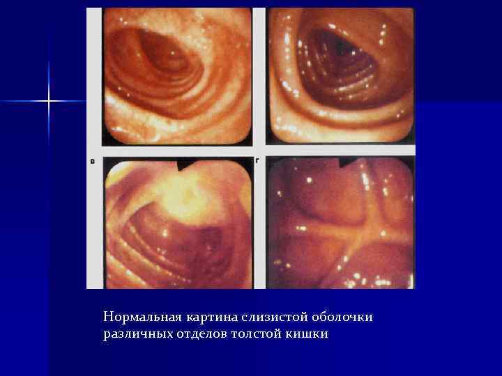 Нормальная картина слизистой оболочки различных отделов толстой кишки Нормальная картина слизистой оболочки различных отделов толстой кишки