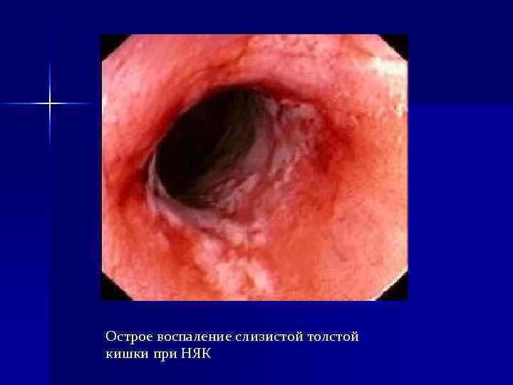 Острое воспаление слизистой толстой кишки при НЯК Острое воспаление слизистой толстой кишки при НЯК