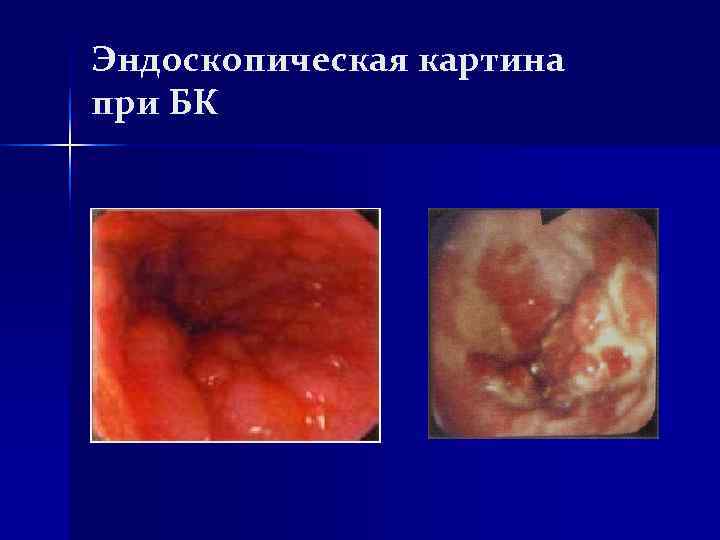 Эндоскопическая картина при БК Эндоскопическая картина при БК