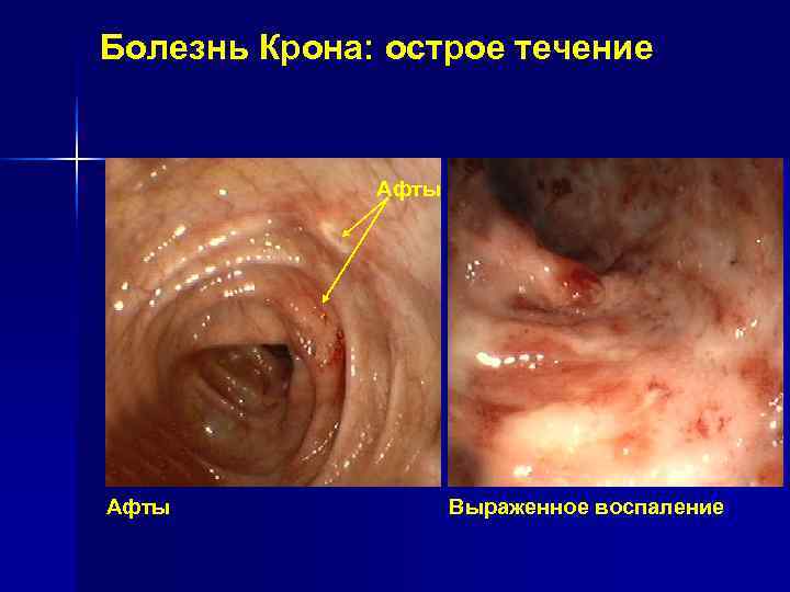 Болезнь Крона: острое течение Афты Выраженное воспаление Болезнь Крона: острое течение Афты Выраженное воспаление