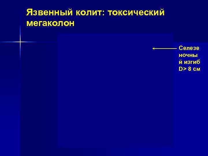 Язвенный колит: токсический мегаколон Селезе Язвенный колит: токсический мегаколон Селезе