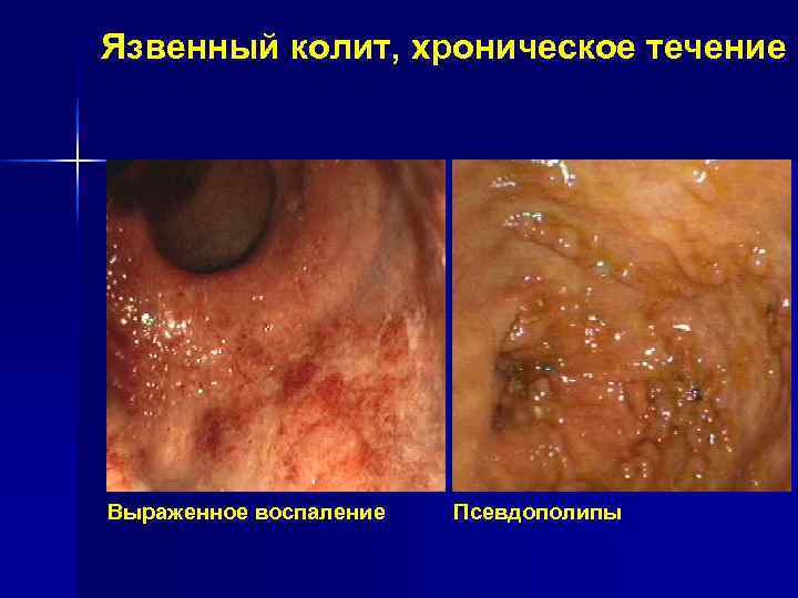Язвенный колит, хроническое течение Выраженное воспаление Псевдополипы Язвенный колит, хроническое течение Выраженное воспаление Псевдополипы