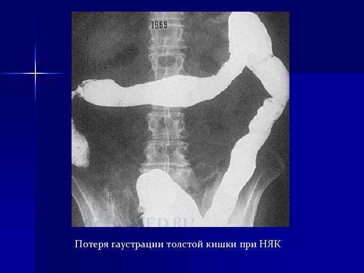 Потеря гаустрации толстой кишки при НЯК Потеря гаустрации толстой кишки при НЯК