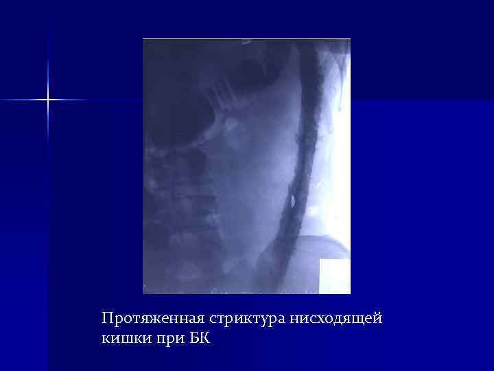 Протяженная стриктура нисходящей кишки при БК Протяженная стриктура нисходящей кишки при БК