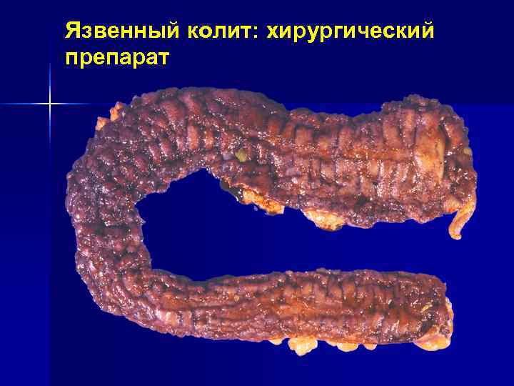 Язвенный колит: хирургический препарат Язвенный колит: хирургический препарат