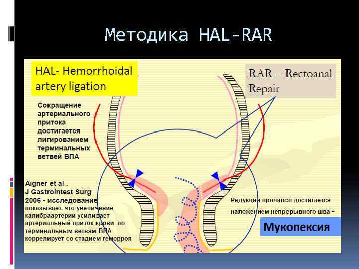 Методика HAL-RAR 