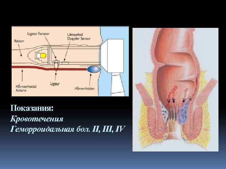 Показания: Кровотечения Геморроидальная бол. II, IV 