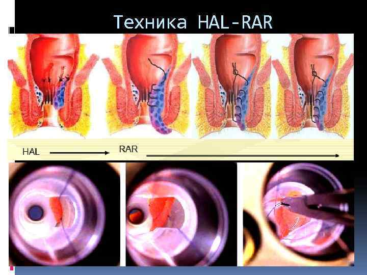 Техника HAL-RAR 