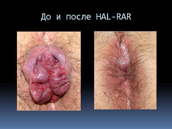 До и после HAL-RAR 