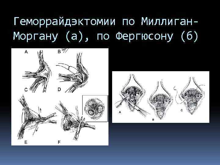 Геморрайдэктомии по Миллиган- Моргану (а), по Фергюсону (б) 