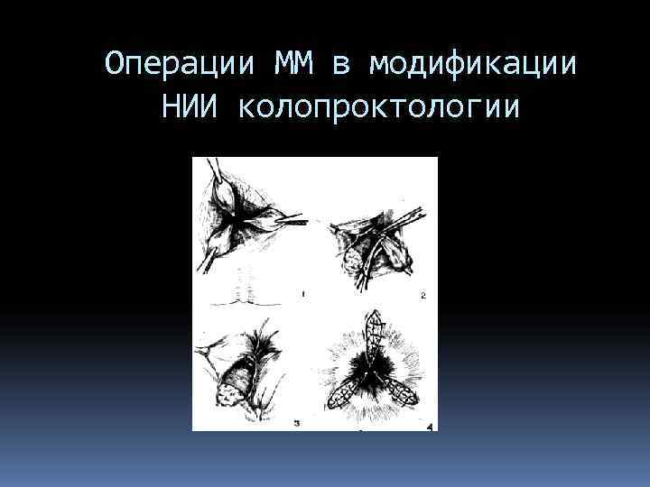 Операции ММ в модификации  НИИ колопроктологии 