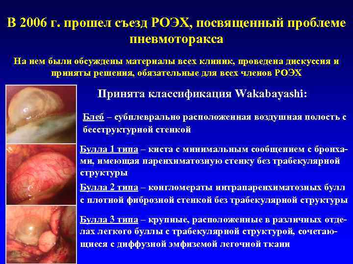 В 2006 г. прошел съезд РОЭХ, посвященный проблеме    пневмоторакса На нем
