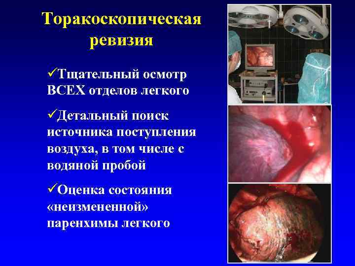Торакоскопическая ревизия üТщательный осмотр ВСЕХ отделов легкого üДетальный поиск источника поступления воздуха, в том