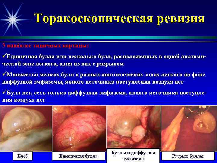   Торакоскопическая ревизия 3 наиболее типичных картины: üЕдиничная булла или несколько булл, расположенных