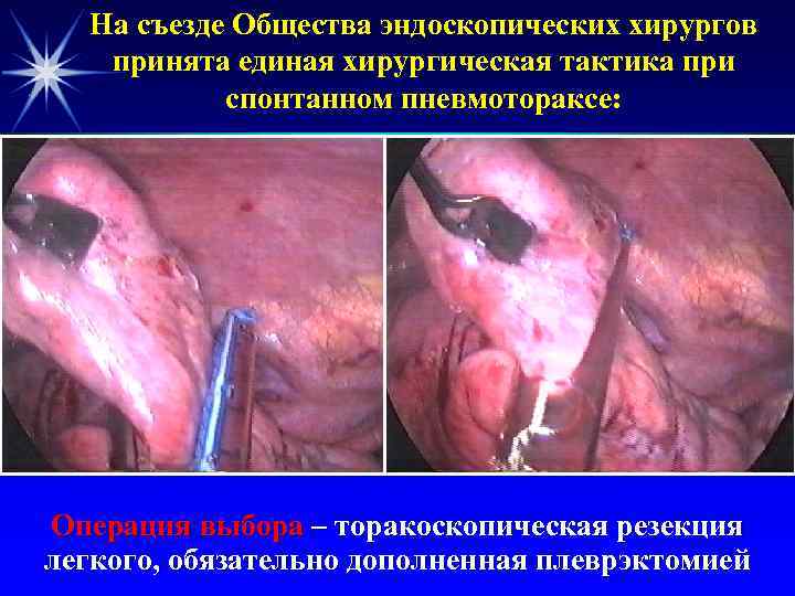  На съезде Общества эндоскопических хирургов  принята единая хирургическая тактика при  спонтанном