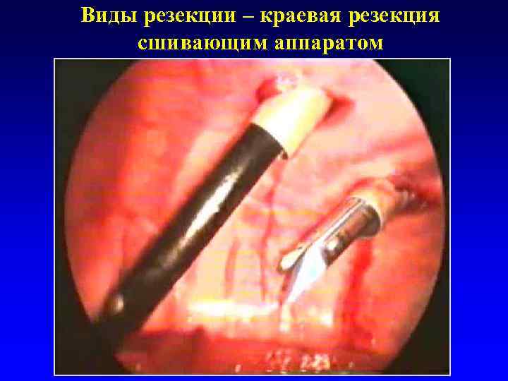 Виды резекции – краевая резекция сшивающим аппаратом 