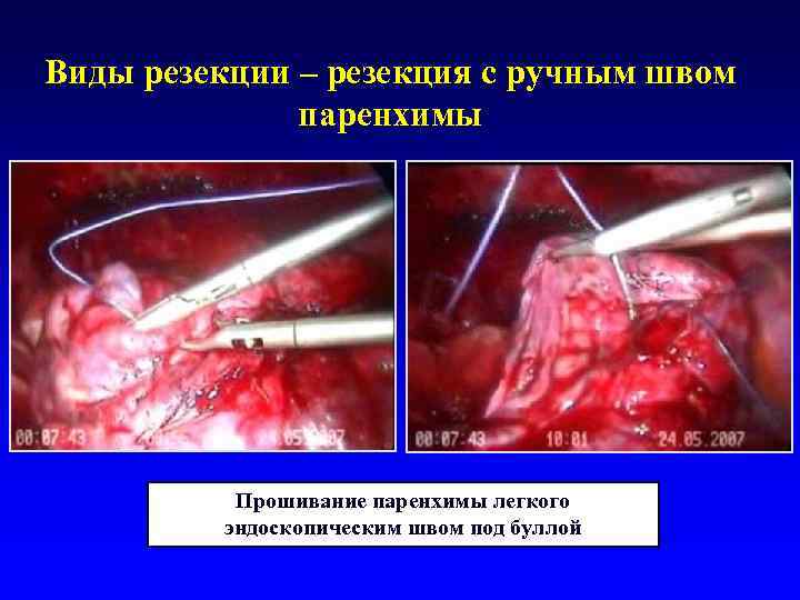 Виды резекции – резекция с ручным швом    паренхимы   