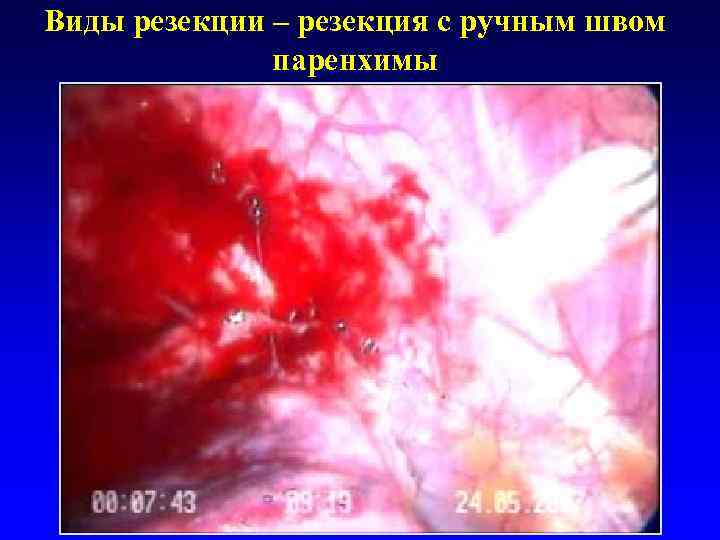 Виды резекции – резекция с ручным швом    паренхимы 