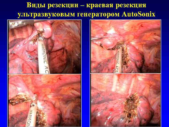  Виды резекции – краевая резекция ультразвуковым генератором Auto. Sonix 
