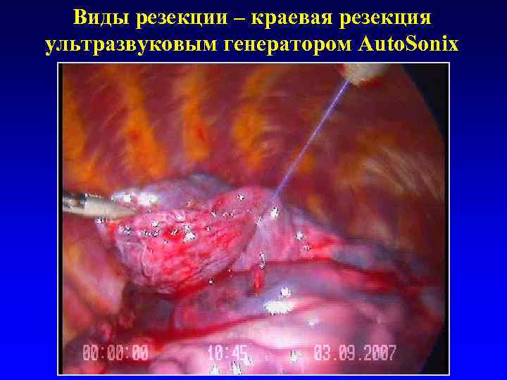  Виды резекции – краевая резекция ультразвуковым генератором Auto. Sonix 